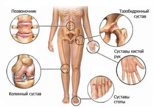 ревматоидный артрит и диабет 1 типа