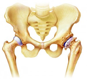 остеоартроз тазобедренного сустава