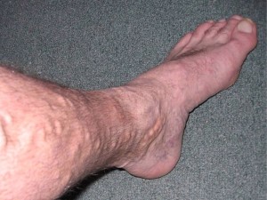варикозное расширение вен ног