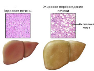 Жировая болезнь печени