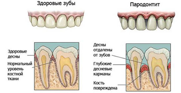 Пародонт при сахарном диабете