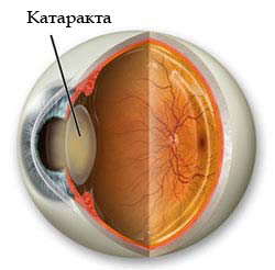 Риск катаракты у людей с диабетом 2 типа