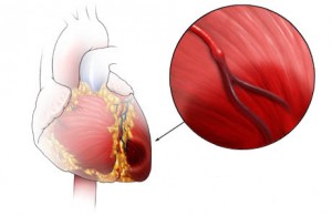 проблемы с сердцем могут вызвать нездоровые кровеносные сосуды