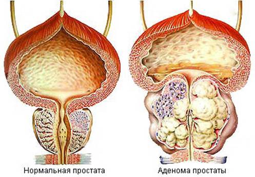 Аденома простаты