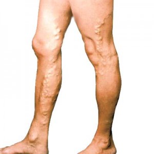Причины и последствия варикозных вен на ногах