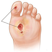 Трофические язвы при диабете