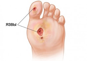 диабетическая стопа лечение