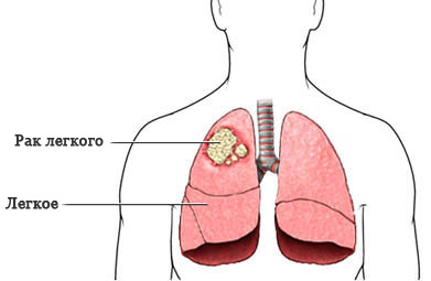 Какие люди чаще болеют раком легких