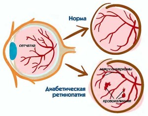 диабетическая ретинопатия