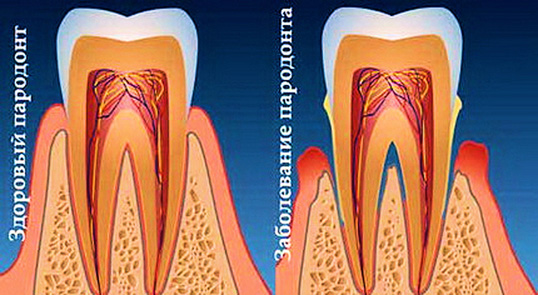 пародонтит зубов