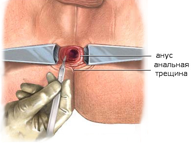 Лечение анальных трещин диетой