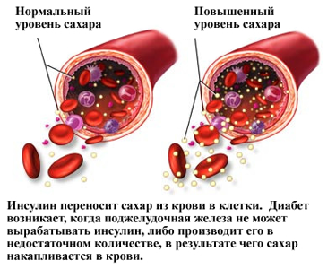 Управление высоким уровнем сахара в крови