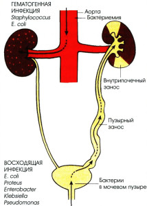 Инфекции мочевыводящих путей