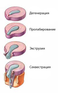 Грыжа поясничного диска