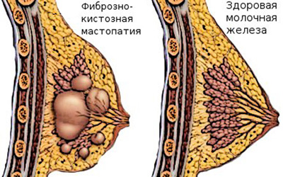 Фиброзно-кистозная болезнь