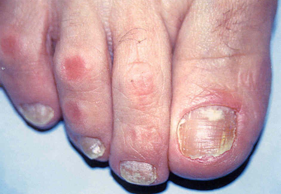 Особенности развития и профилактика грибковой инфекции ногтей (онихомикоза) при сахарном диабете