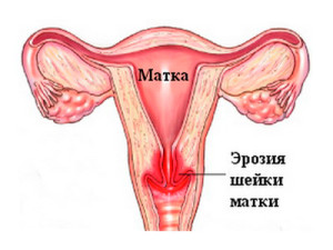 Признаки эрозии шейки матки