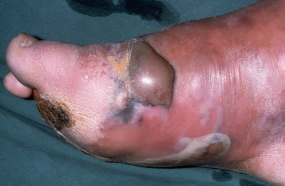 Анаэробная неклостридиальная инфекция мягких тканей
