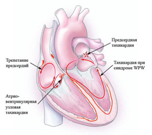 Тахикардия