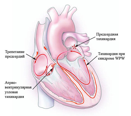 Тахикардия сердца