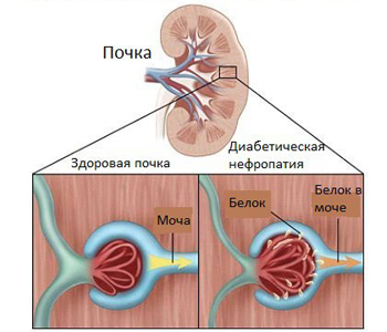 Проблемы с почками – диабетическая нефропатия
