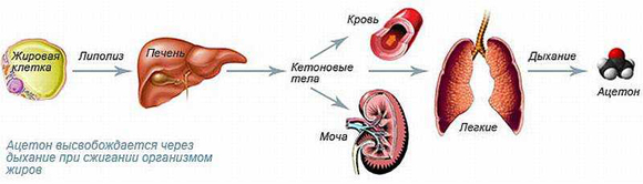 Кетоацидоз