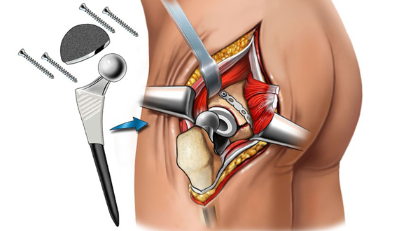 эндопротезирование тазобедренного сустава