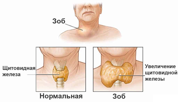 Заболевания щитовидной железы