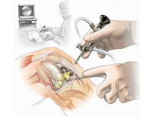 Особенности артроскопической хирургии