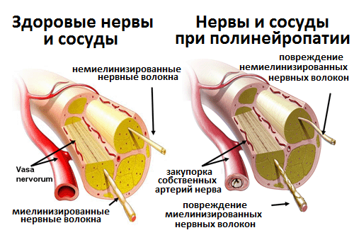 Автономная нейропатия