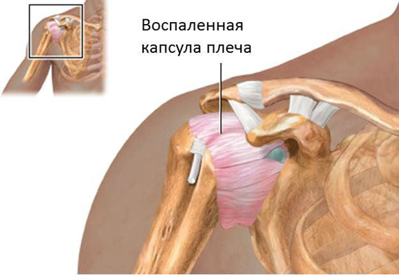 Капсулит плечевого сустава