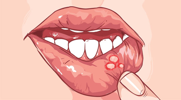 Инфекции полости рта