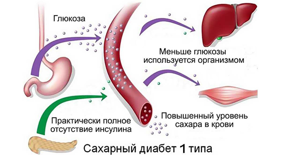 Причины развития диабета 1 типа