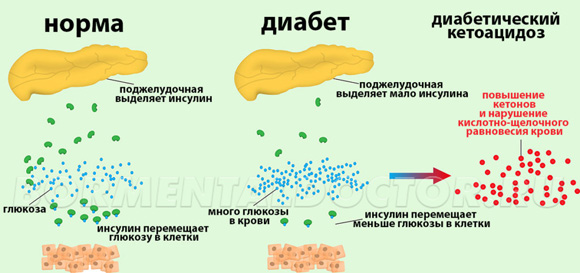 Кетоацидоз