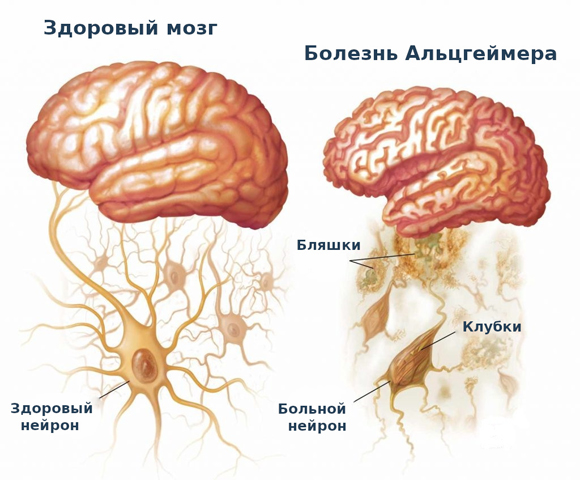 Мозг больного Альцгеймером