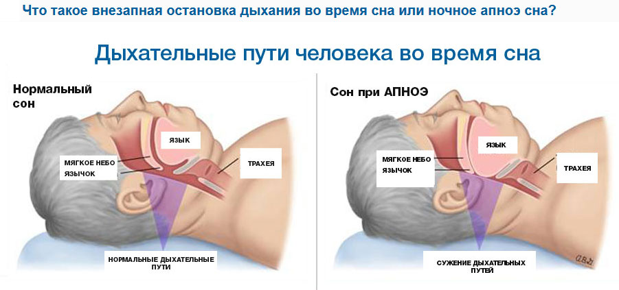 Диабет и апноэ во сне